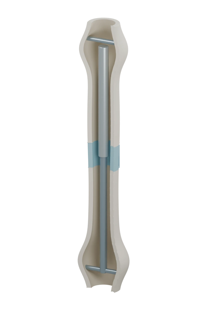 The same cutaway bone with its two segments farther apart. Blue tissue occupies the new space around the nail.